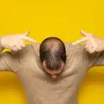 Paciente con calvície incipiente